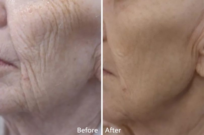 Before and after — visible smoothing